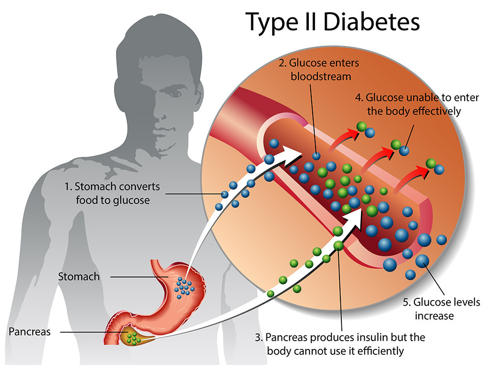 Penyebab Diabetes Melitus