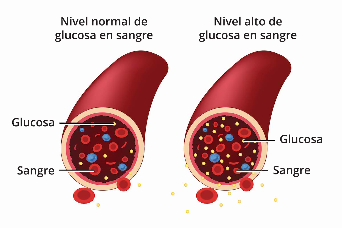 Penyebab Diabetes Melitus