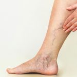 Chronic Venous Insufficiency