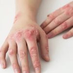 Impetigo