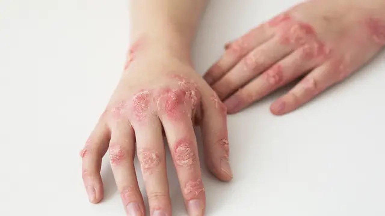 Impetigo