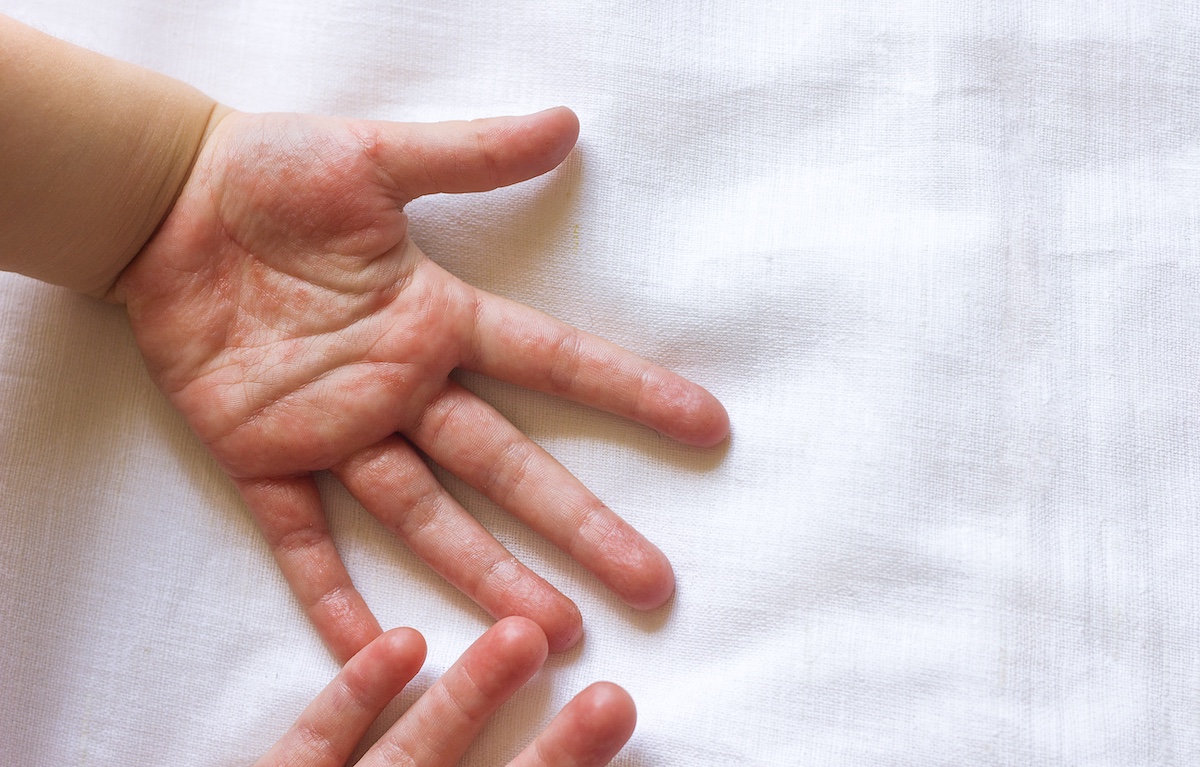 Mengapa Impetigo Tidak Boleh Diabaikan