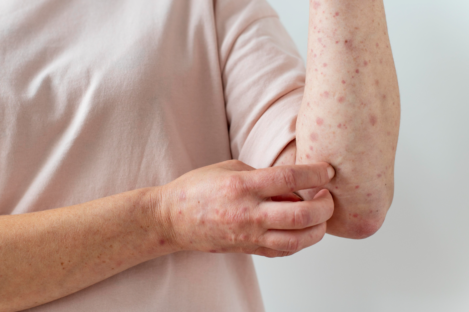 Mengenal Impetigo dan Penyebab Utamanya